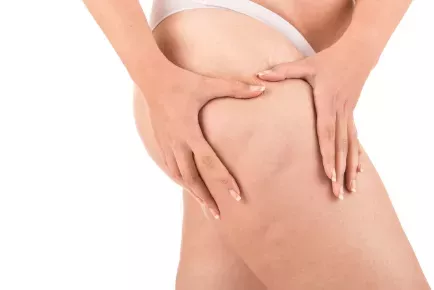 Cellulite Treatment